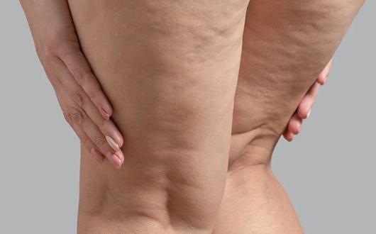 LİPÖDEM NEDİR? LİPÖDEM NEDİR?